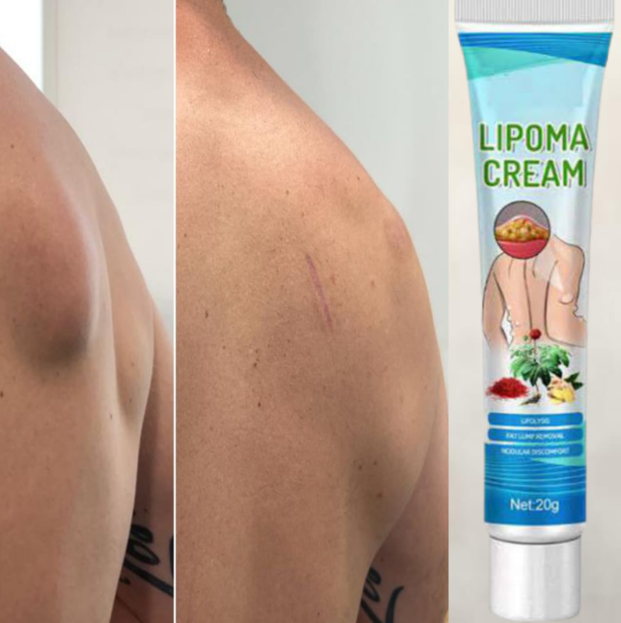 Lipoma Removal Cream – Natural Herbal Formula for Fat Lump Reduction & Skin Comfort