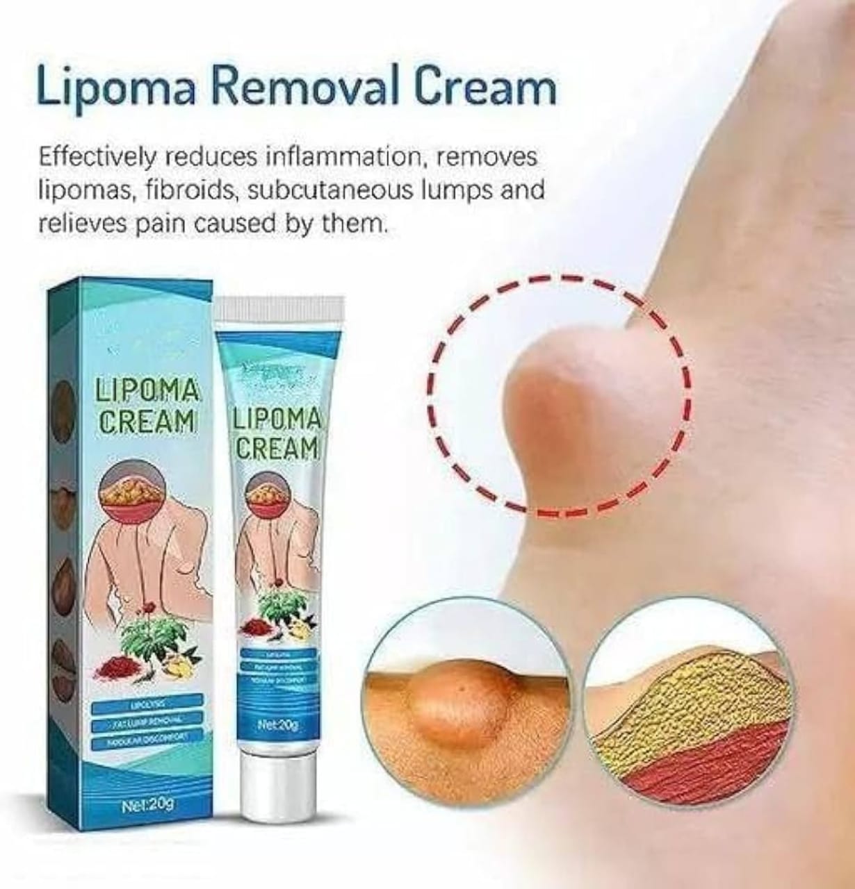 Lipoma Removal Cream – Natural Herbal Formula for Fat Lump Reduction & Skin Comfort